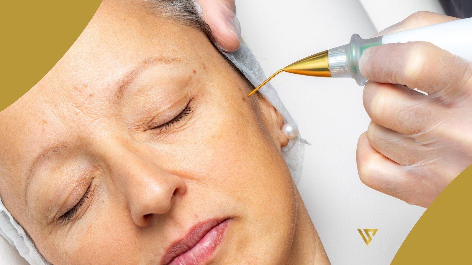 Woman with closed eyes, hand applying treatment near the cheek, Plasma Fibroblast beauty spa