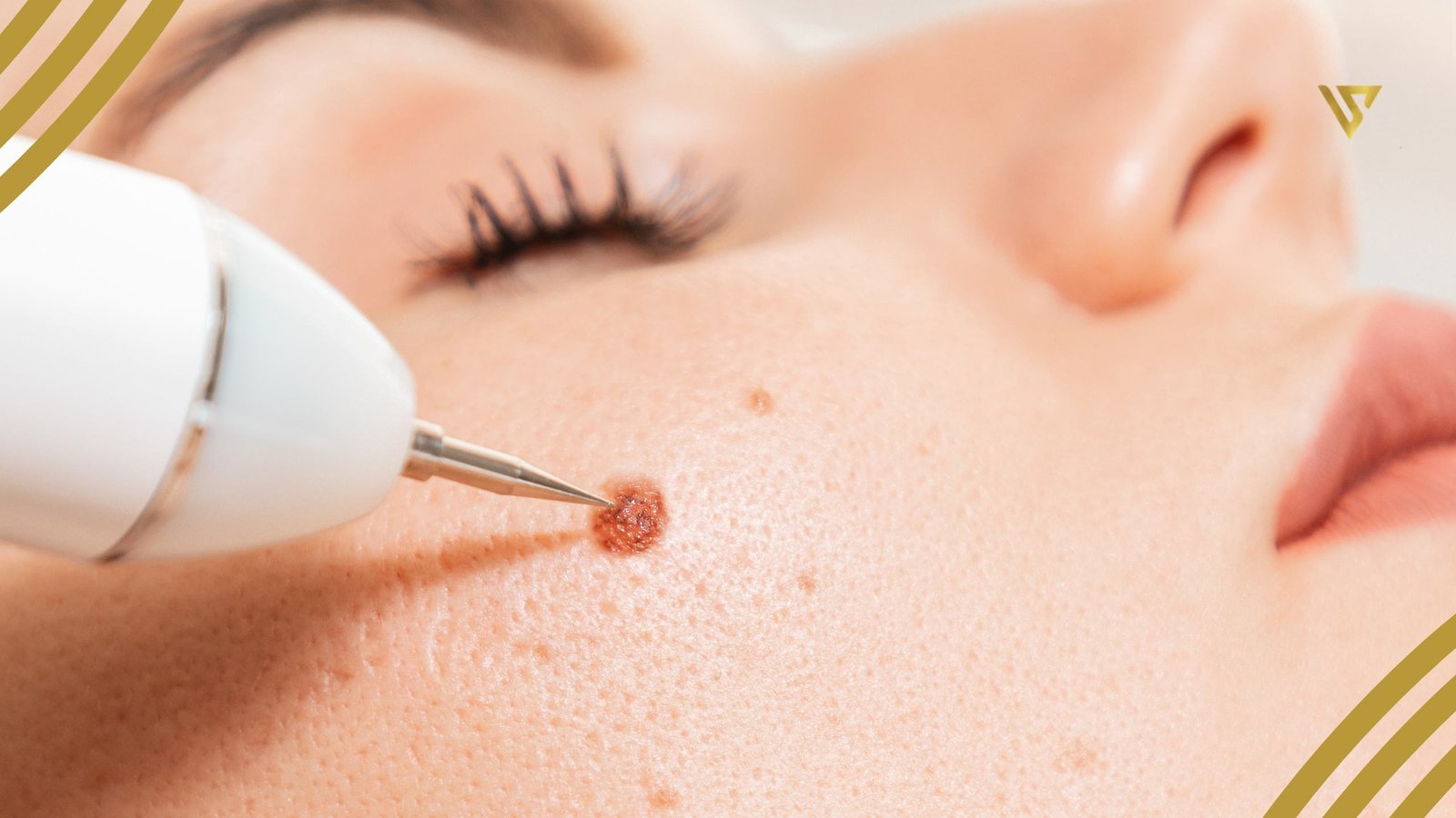 Machine on face to remove a mole beauty spa by val skin tag removal