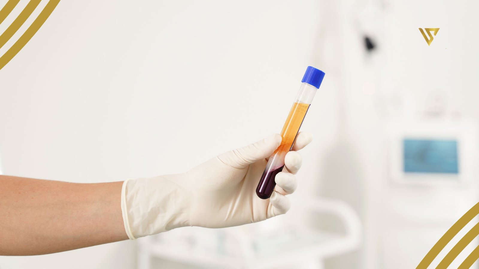 Hand holding a test tube with separated blood and plasma Does Platelet-Rich Plasma Really Work?
beauty spa by val