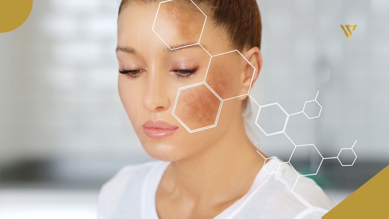 Young woman wearing a white shirt, with visible hyperpigmentation spots on her forehead and left cheek, and hexagonal graphics highlighting the pigmented areas. Treating Different Types of Pigmentation. Beauty Spa by Val