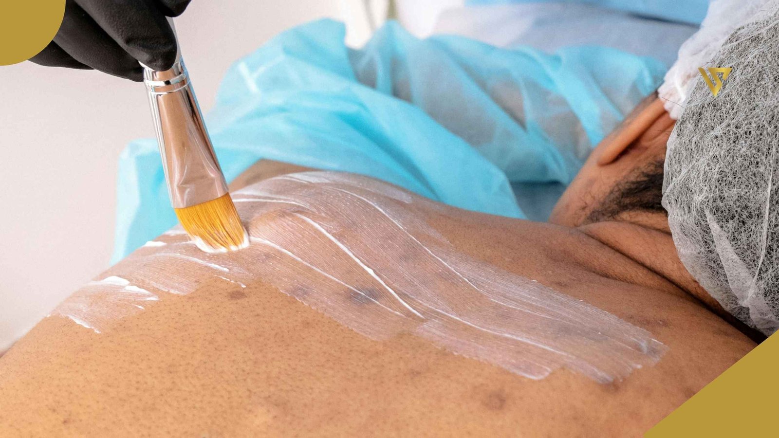 Person lying face down on an examination table. Their left arm is covered with a blue surgical drape, and their hair is covered with a white surgical cap. A second person's right hand, wearing a black latex glove, is holding a brush that is applying a white liquid to the person's back. What Is a Back Facial and How Does It Treat Body Acne. Beauty spa by Val
