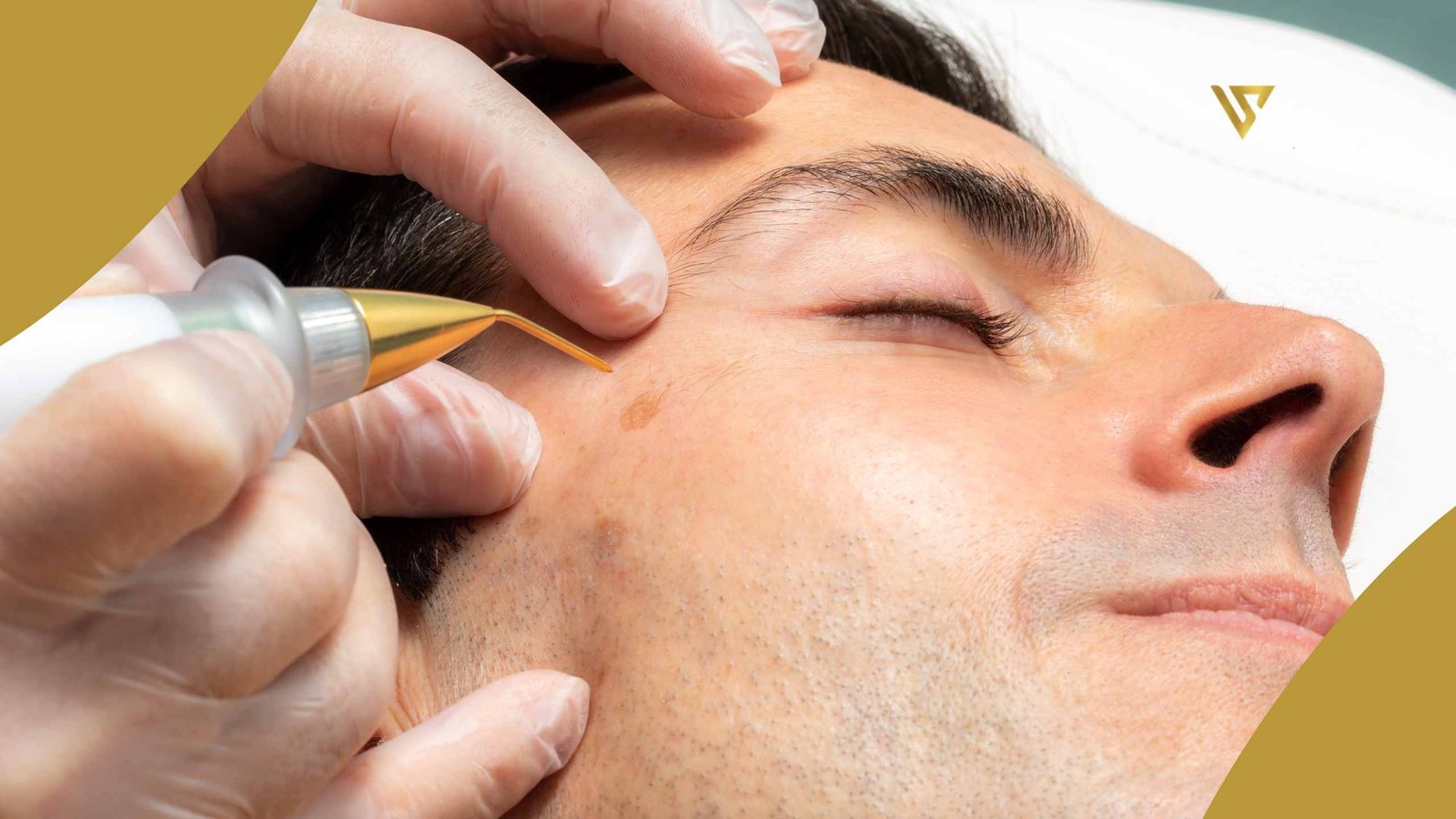 Man with closed eyes, hand applying treatment near the eye, Plasma Fibroblast