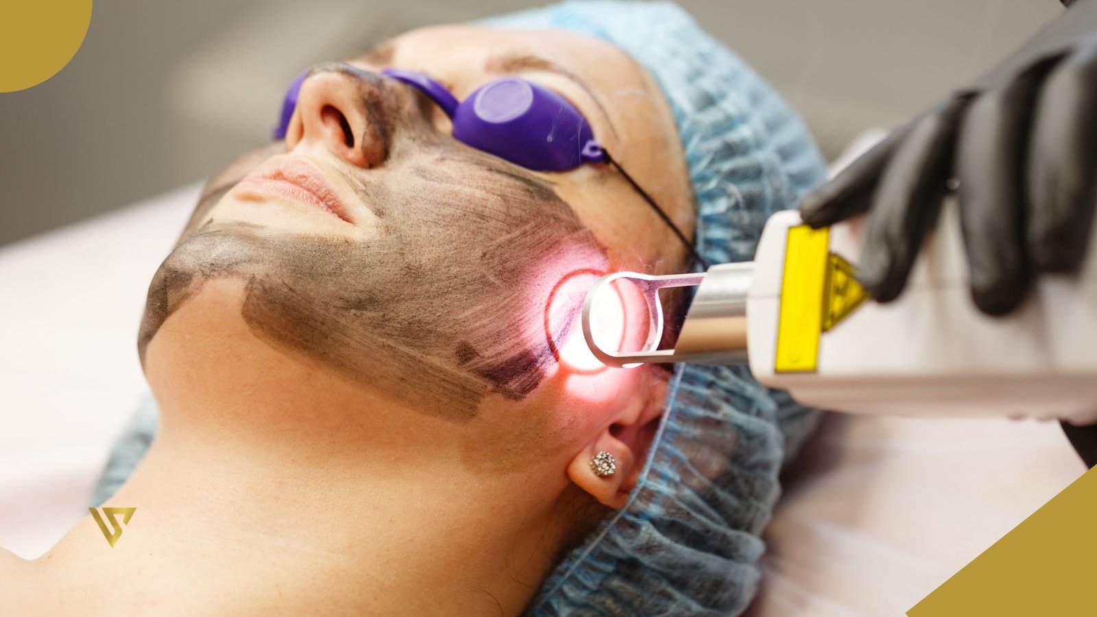 A woman lying on a treatment bed, her face covered with a charcoal mask, wearing purple laser safety goggles over her eyes, a blue cap covering her hair, a white and yellow CO2 laser device, her left hand wearing a black glove holding the laser device, and a white earring in her left ear, beauty spa by val, Hollywood Peel vs Other Advanced Facial Treatments