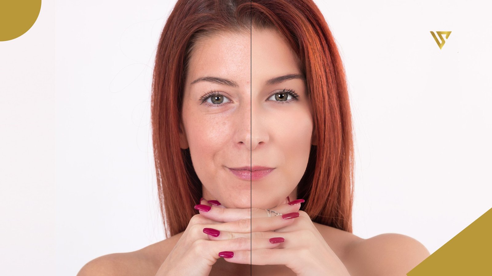 Young red-haired woman looking forward with her face divided into two halves to show a before-and-after facial treatment result, hands resting under her chin, against a minimalist white background. Nasolabial Fold Treatment: What Are Your Options Without Surgery? Beauty Spa by Val