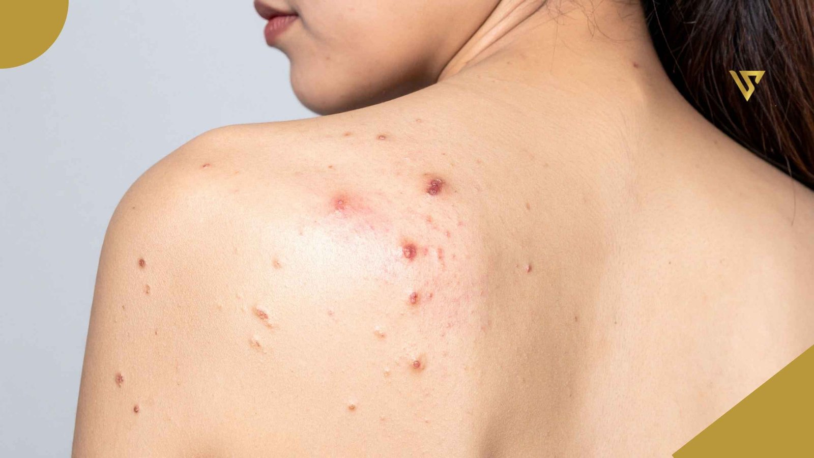 Woman viewed from behind, looking toward the left. The lower third of her face is visible. Her back is bare, with acne visible on her left shoulder blade. She has dark hair. Body Acne: Causes, Treatments, and How a Back Facial Can Help. Beauty spa by Val.