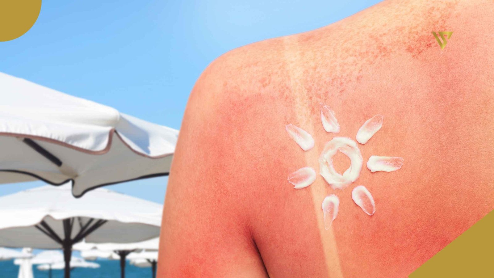 Woman seen from behind, showing her left shoulder with a tan line from a bra strap. The skin appears reddish, with spots and sunscreen applied in the shape of a sun. Background of blue sky and white parasols with black bases, Sun Damage Repair: Best Professional Treatments After a Florida Summer, Beauty Spa by Val